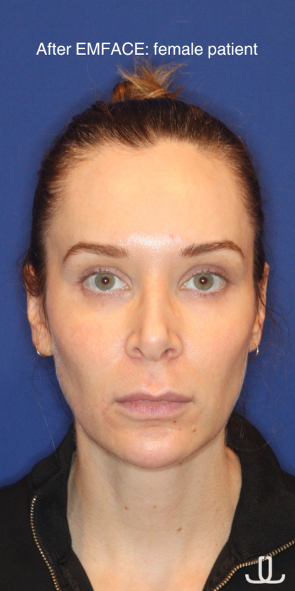Emface Before & After Patient #15035